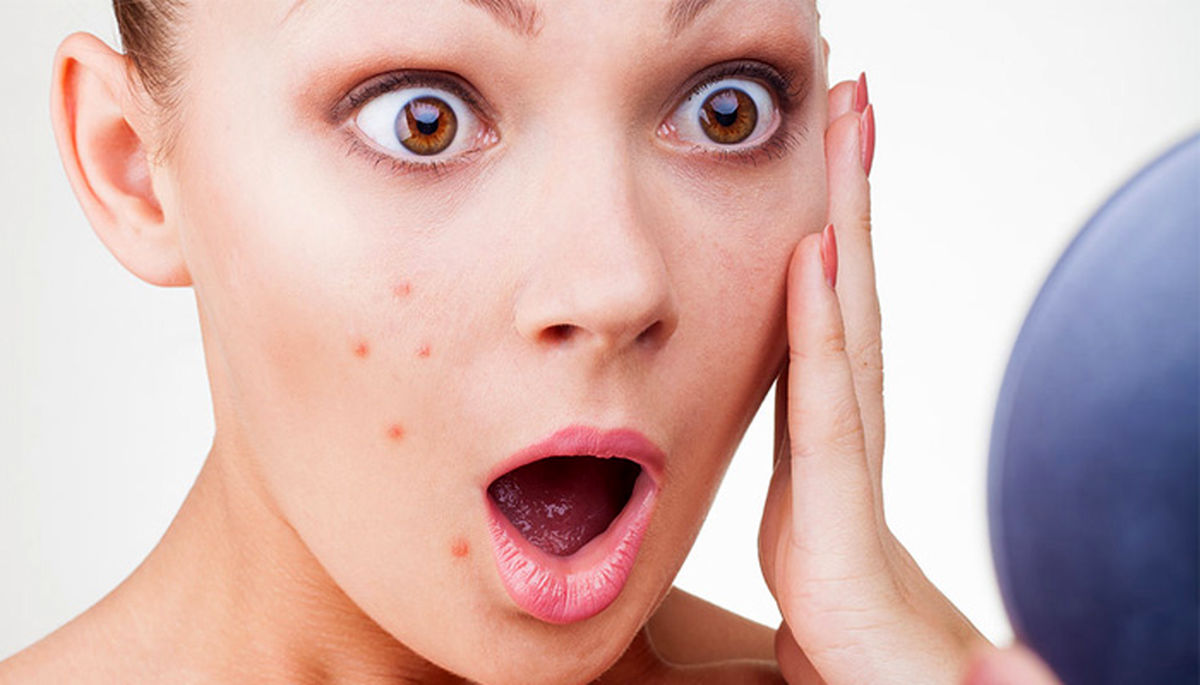 راه حل معجزه آسا؛یک شبه از جوش صورت راحت شوید